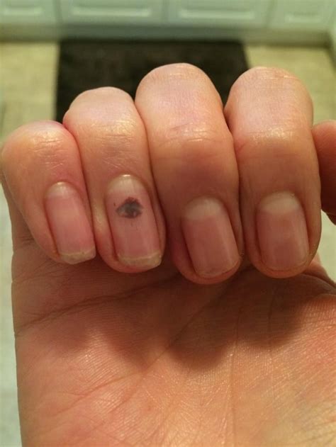 My fingernail blood blister looks like an eye. : mildlyinteresting