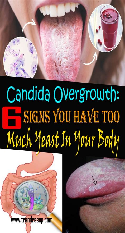 Candida Overgrowth: 6 Signs You Have Too Much Yeast In Your Body ...