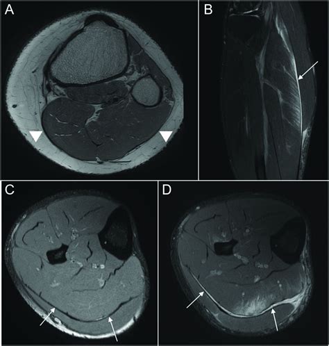 Connective tissue injury in calf muscle tears and return to play: MRI ...