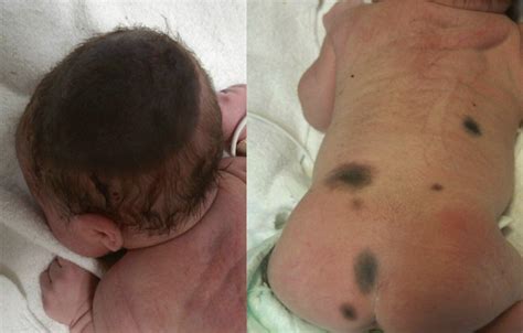 Congenital Nevus Article