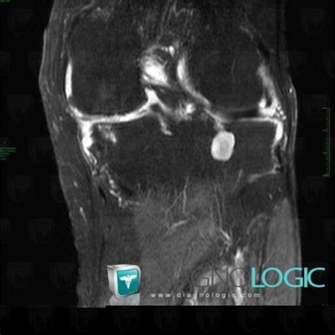 Radiology case : Subchondral cyst (MRI) - Diagnologic