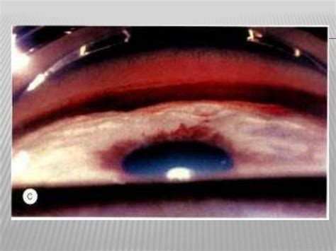 Neovascular glaucoma