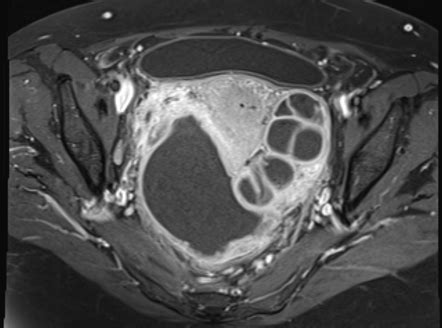 Tubo Ovarian Abscess Radiopaedia