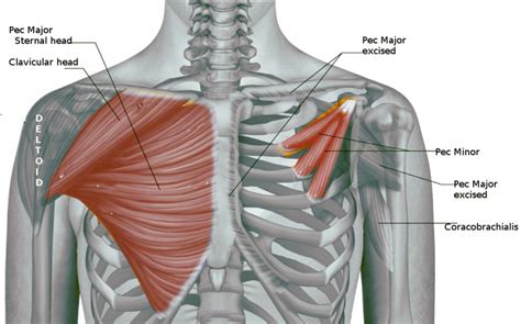 [Figure, Pectoralis Muscles Image courtesy Dr Chaigasame] - StatPearls ...