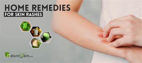 10 Simple and Best Home Remedies for Skin Rashes