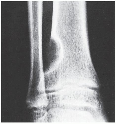 Benign Tumors and Tumor-like Lesions III: Fibrous, Fibroosseus, and ...