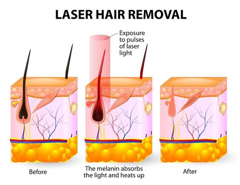 Laser Hair Removal Treatment in Mumbai and Delhi, India | Permanent ...