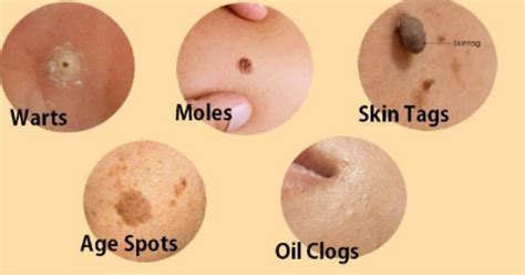 How to Easily Remove Skin Tags, Moles, Blackheads, Spots, and Warts ...