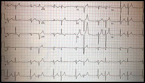 ECG Challenge: Palpitations & Insomnia in Middle Age