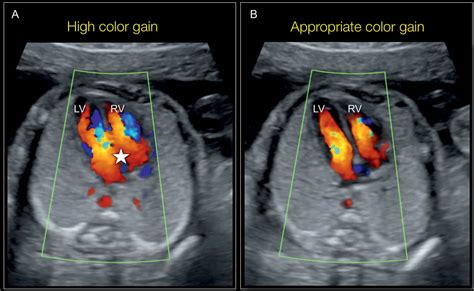 Color Doppler ultrasonogram of the liver showing patency of the hepatic ...