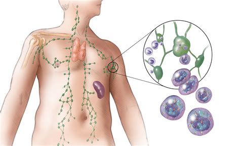 Determining Prognosis for Patients With Diffuse Large B-Cell Lymphoma ...