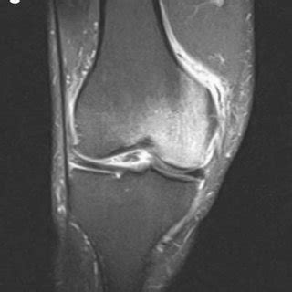 (PDF) [Bone marrow edema in the knee. Differential diagnosis and ...