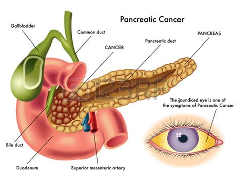 Cáncer de páncreas, el más mortal de su especie. Evítelo