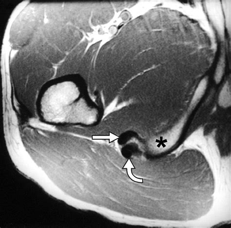 Hamstring Tendon Anatomy Mri