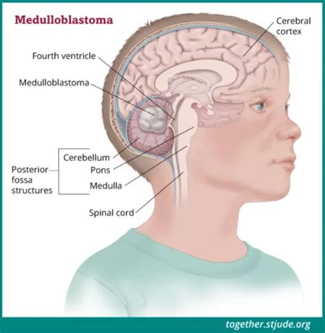 [Download 10+] 13+ Posterior Cranial Fossa Gif GIF