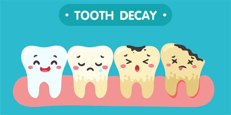 Top Causes Of Tooth Decay, Symptoms and Treatment