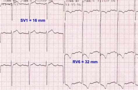 Sokolow-Lyon criteria for left ventricular hypertrophy – All About ...