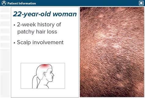 Hair Disorders: Finding the Root of the Problem