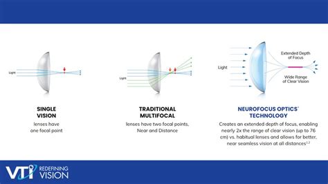 Understanding the NaturalVue multifocal contact lens - Myopia Profile