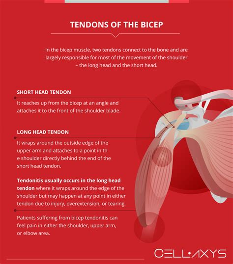 Bicep Tendonitis: Shoulder Pain And Treatment - Cellaxys