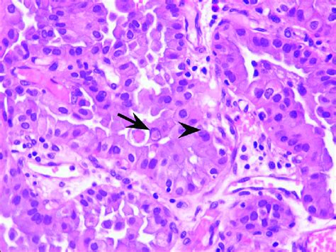 Metastasis of thyroid papillary carcinoma in the brain. Nuclear ...