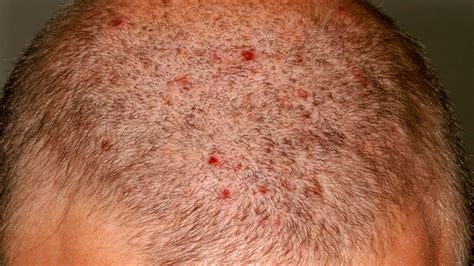 Why Do I Have Big, Small, Red Itchy Bumps on My Scalp? - American Celiac