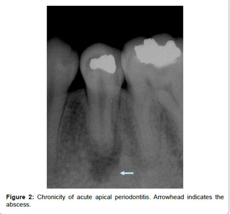 Acute Apical Periodontitis Radiograph