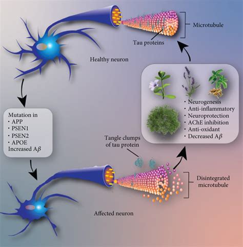 Alzheimer’s disease. Condition of high neurofibrillary tangles and ...