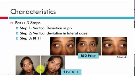 Causes For Strabismus: Cranial Nerve Palsy PinpointEyes, 41% OFF