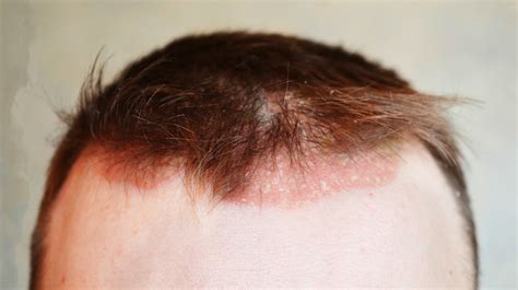 How To Treat Eczema On Scalp Naturally | Puriya Blog | Eczema