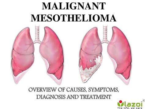 Malignant Mesothelioma: Overview of symptoms, diagnosis and treatment