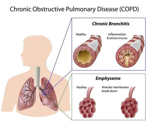 Copd Disease Process | scs-oman.com