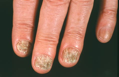 Nail fungus - symptoms, causes and risk factors - Home Remedy and ...