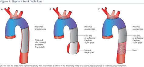 Elephant Trunk Technique | Radcliffe Vascular