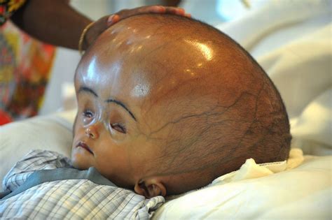 Swollen-head Baby: Parents Of Roona Begum Plead For More Financial Aid ...