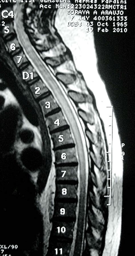 Case 1.MRI of cervical and thoracic spinal cord showing T2-weighted ...