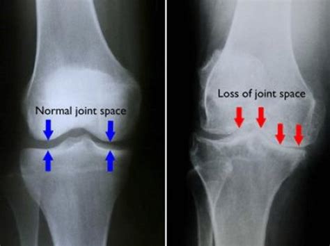 Pictorial representation of X-Ray image of human normal Knee joint and ...