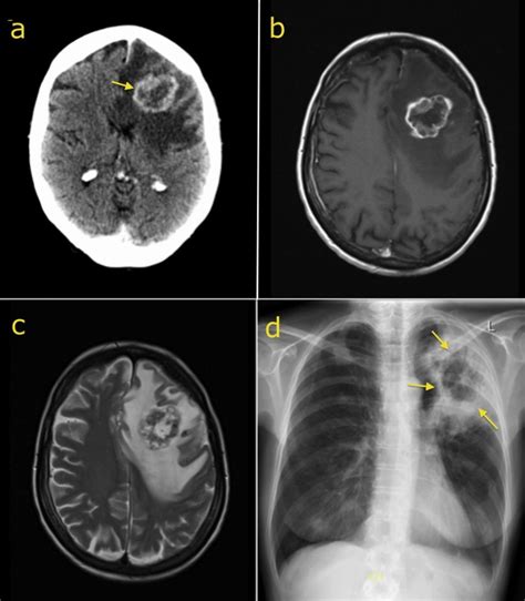 Brain metastasis - Radiology at St. Vincent's University Hospital