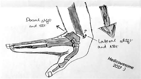 Medicowesome: Colles' fracture