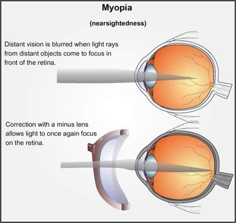 Myopia (Short Sightedness) | Beckenham Optometrist