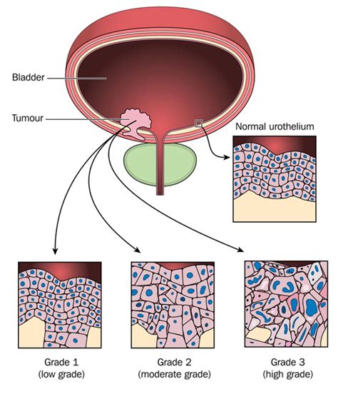 Bladder Cancer Symptoms: Seek an Evaluation for Early Detection ...