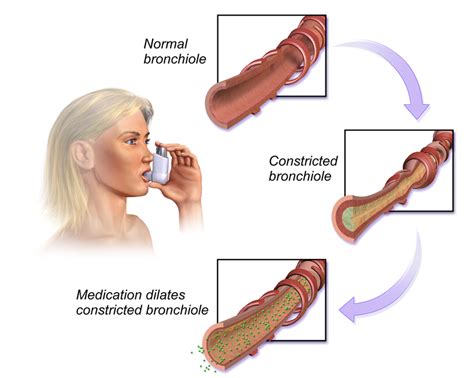 Chronic Bronchitis - Physiopedia