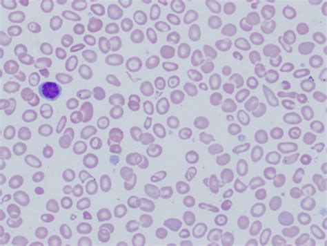 Thalassemia Blood Smear