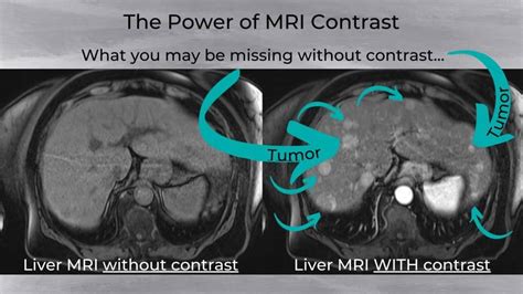 Can I Refuse Contrast Dye for MRI Scans?