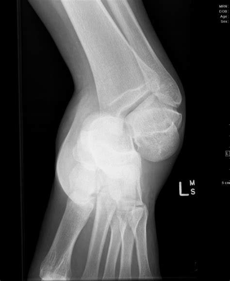 Subtalar Dislocations — BROWN EMERGENCY MEDICINE