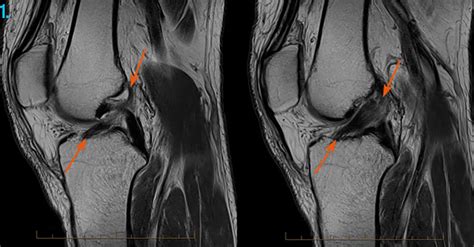 Normal Mri Knee