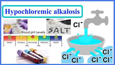 hypochloremic alkalosis - YouTube