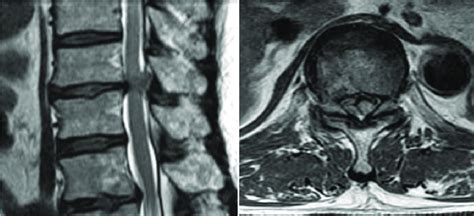 Herniated Disc Thoracic Mri