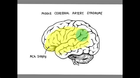 ACA and MCA syndrome - YouTube