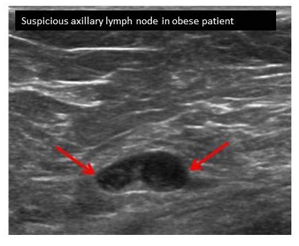 Lymph Node Ultrasounds More Accurate in Obese Breast Cancer Patients ...